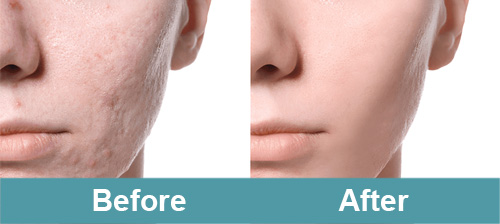 Acne Scars Treatment Before and After