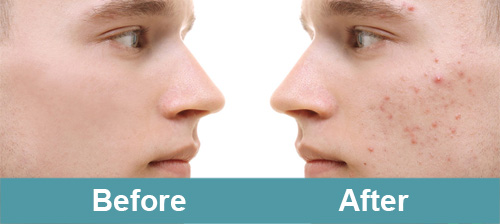 Acne Scars Treatment Before and After