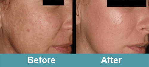 Acne Scars Treatment Before and After