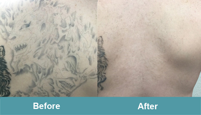 Laser Tattoo Removal