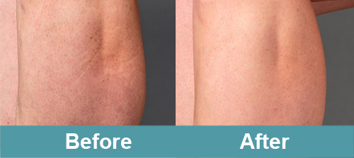 Legs & Feet Before & After Photos