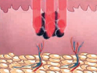 Melanin granules absorbing laser energy