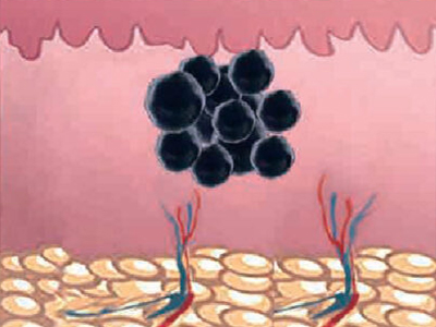 Melanin granules in skin