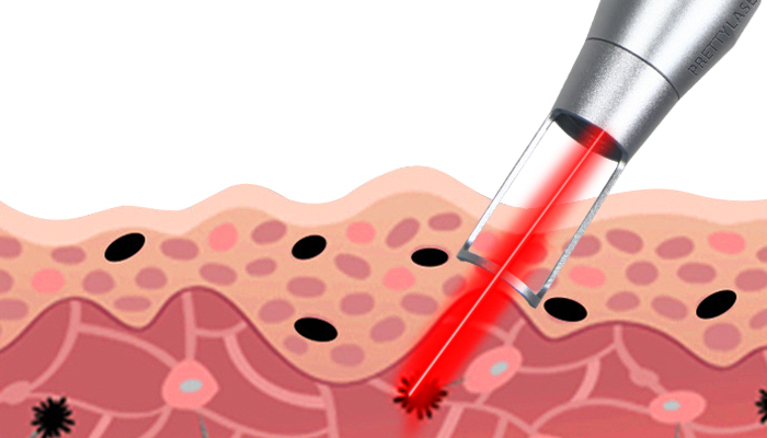 Picosecond Laser Technology