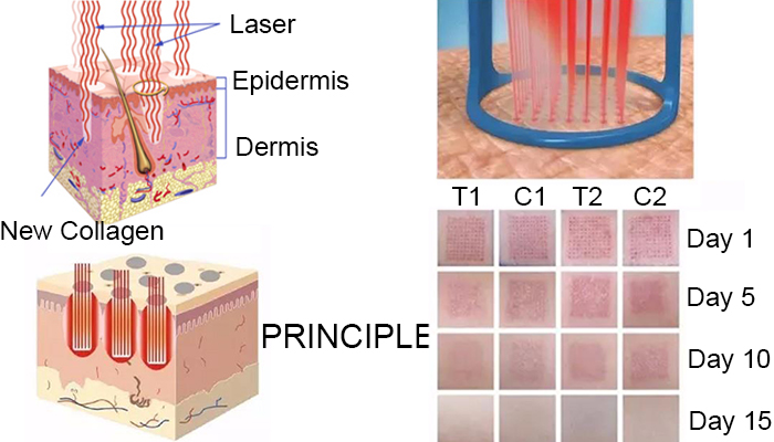 Fractional Co2 Laser Working Principle