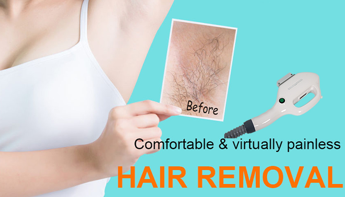 Intense Pulsed Light Hair Removal