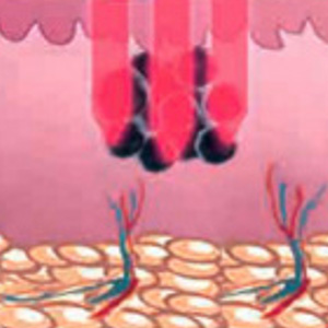 Melanin granules absorb laser energy