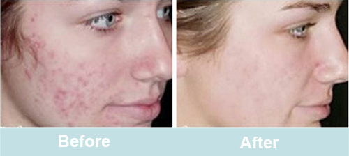 day by day co2 laser resurfacing recovery photos
