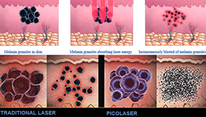 Pico Laser Technology