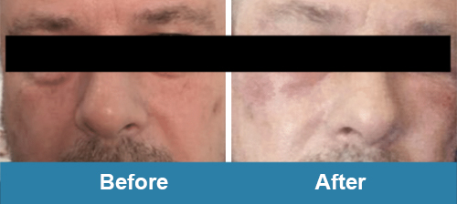 Plasma Skin Care before after treatment