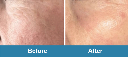 Plasma Skin Rejuvenation before after treatment