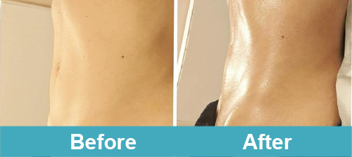 lymphatic drainage before and after