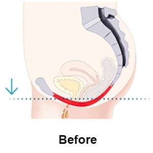 Pelvic floor muscles insufficiently support pelvic organs and affect bladder control.