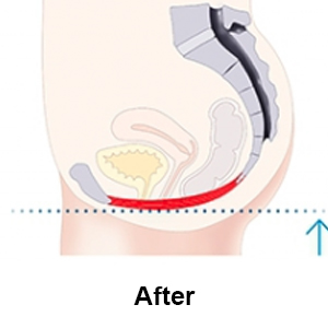 Stimulation leads to regained control over pelvic floor muscles and bladder.