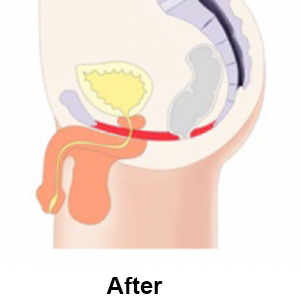 Stimulation leads to regained control over bladder and pelvic floor muscles which can lead to increased intimate satisfaction.