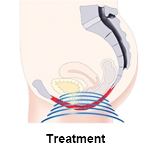 EMS Magic Chair effectively stimulates pelvic floor muscles with thousands of supramaximal contractions per session.