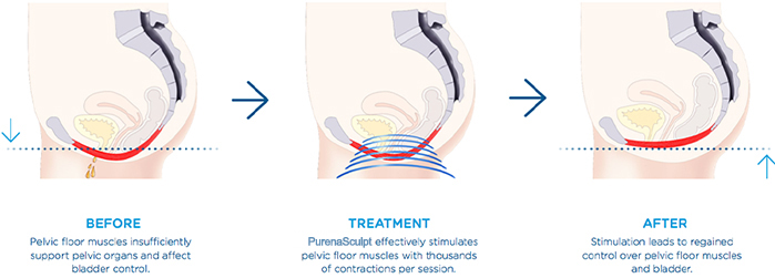 Pelvic Floor Treatment Principle