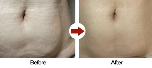 abdomen Before After