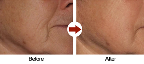 face lifting Before After