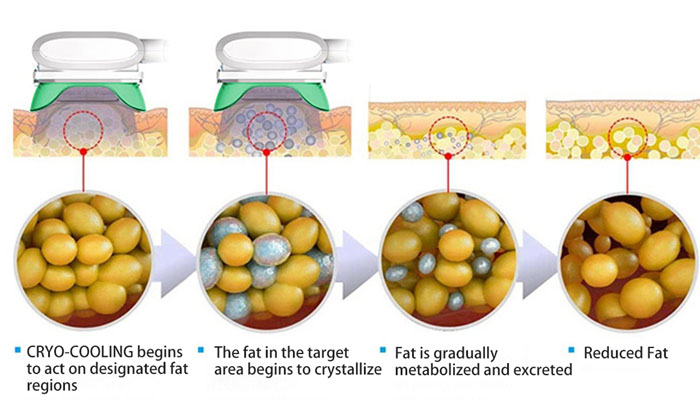 360-Degree Cryolipolysis: Fat Freezing and Cellulite Reduction