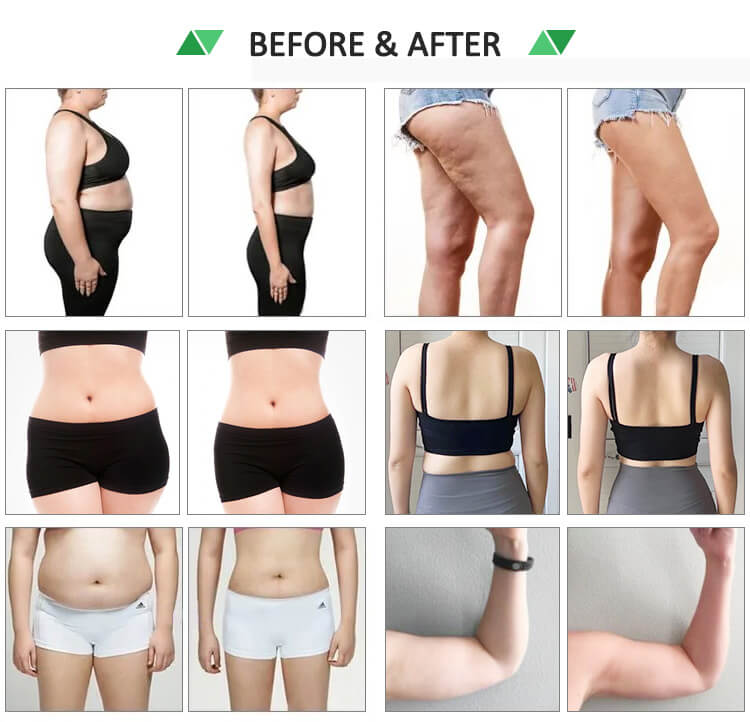 Prenaslasers® GCP532 PRO  Treatment