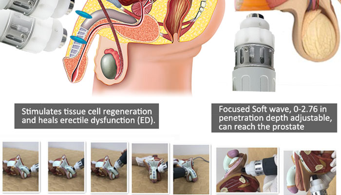 Shock Wave for ED Therapy