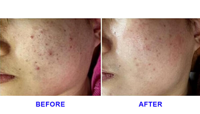 Targeted Skin Solutions with Fusion Plasma Device PL-FP1