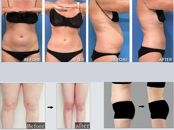 Clinical Applications of 980nm + 1470nm Laser for Fat Reduction