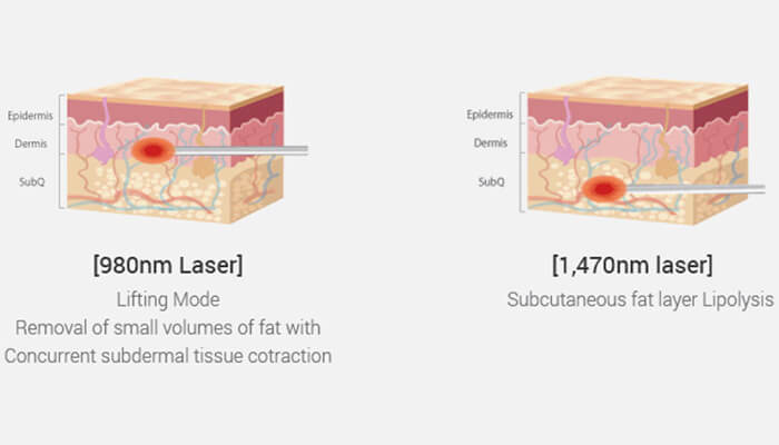 How Does 980nm+1470nm Laser Lipolysis Work?
