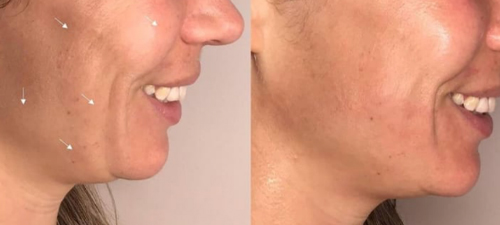 ultraformer before after for face