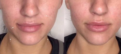 ultraformer before after for face