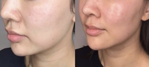 ultraformer before after for face
